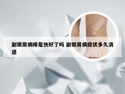 副银屑病痒是快好了吗 副银屑病症状多久消退