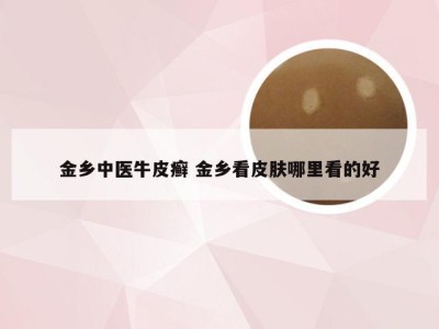 金乡中医牛皮癣 金乡看皮肤哪里看的好
