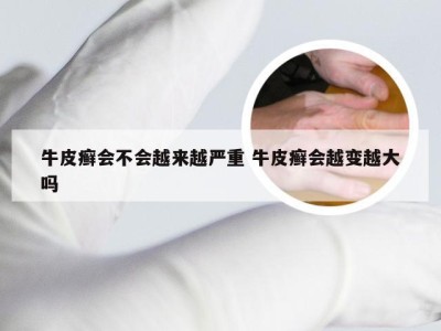 牛皮癣会不会越来越严重 牛皮癣会越变越大吗