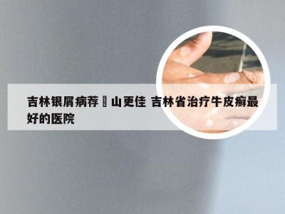 吉林银屑病荐崋山更佳 吉林省治疗牛皮癣最好的医院