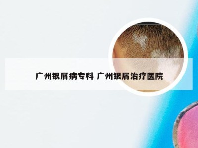 广州银屑病专科 广州银屑治疗医院