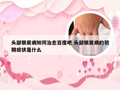 头部银屑病如何治愈百度吧 头部银屑病的初期症状是什么