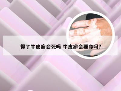 得了牛皮癣会死吗 牛皮癣会要命吗?