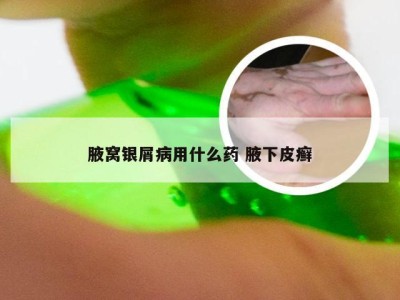 腋窝银屑病用什么药 腋下皮癣