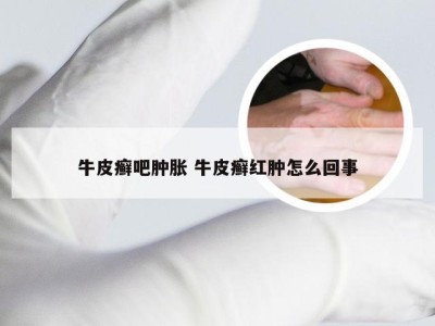 牛皮癣吧肿胀 牛皮癣红肿怎么回事