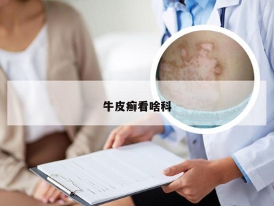 牛皮癣看啥科