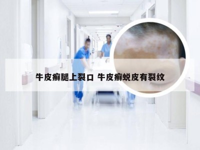 牛皮癣腿上裂口 牛皮癣蜕皮有裂纹