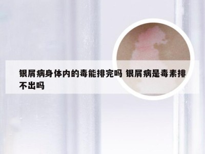 银屑病身体内的毒能排完吗 银屑病是毒素排不出吗