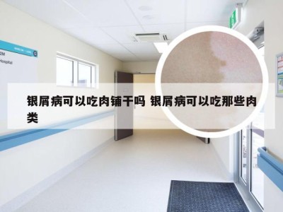 银屑病可以吃肉铺干吗 银屑病可以吃那些肉类