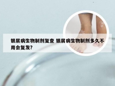 银屑病生物制剂复查 银屑病生物制剂多久不用会复发?