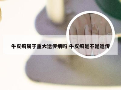 牛皮癣属于重大遗传病吗 牛皮癣是不是遗传