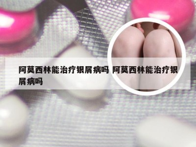 阿莫西林能治疗银屑病吗 阿莫西林能治疗银屑病吗