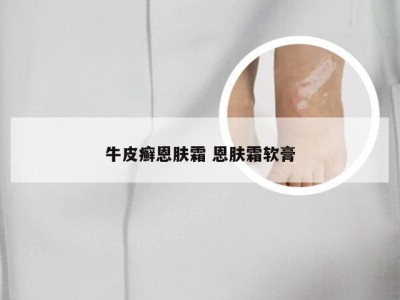 牛皮癣恩肤霜 恩肤霜软膏