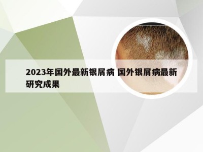 2023年国外最新银屑病 国外银屑病最新研究成果