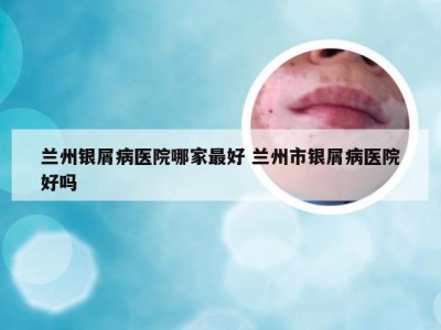 兰州银屑病医院哪家最好 兰州市银屑病医院好吗