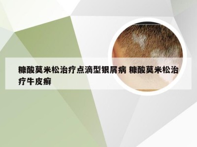 糠酸莫米松治疗点滴型银屑病 糠酸莫米松治疗牛皮癣