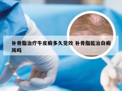 补骨脂治疗牛皮癣多久见效 补骨脂能冶白癣风吗