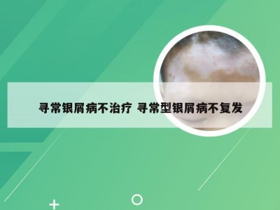 寻常银屑病不治疗 寻常型银屑病不复发
