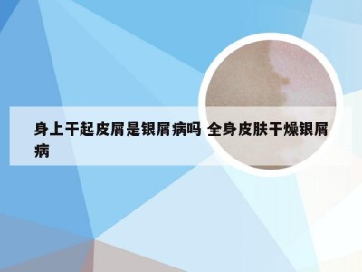 身上干起皮屑是银屑病吗 全身皮肤干燥银屑病