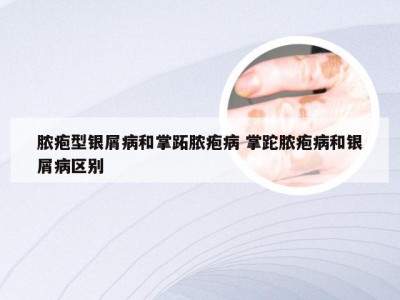 脓疱型银屑病和掌跖脓疱病 掌跎脓疱病和银屑病区别