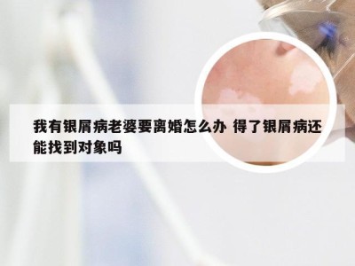 我有银屑病老婆要离婚怎么办 得了银屑病还能找到对象吗