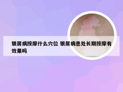 银屑病按摩什么穴位 银屑病患处长期按摩有效果吗