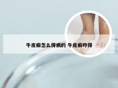牛皮癣怎么得病的 牛皮癣咋得