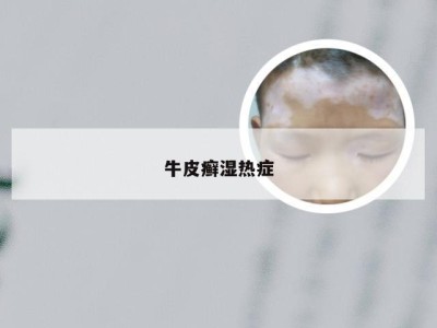 牛皮癣湿热症
