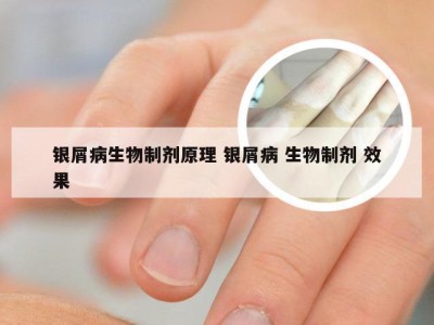 银屑病生物制剂原理 银屑病 生物制剂 效果