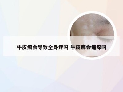 牛皮癣会导致全身疼吗 牛皮癣会痛痒吗
