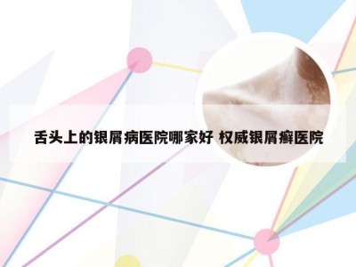 舌头上的银屑病医院哪家好 权威银屑癣医院