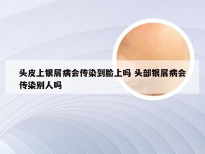 头皮上银屑病会传染到脸上吗 头部银屑病会传染别人吗
