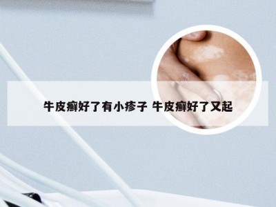 牛皮癣好了有小疹子 牛皮癣好了又起