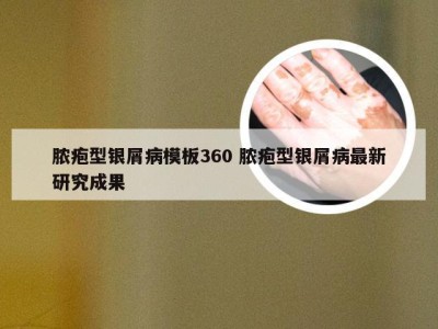 脓疱型银屑病模板360 脓疱型银屑病最新研究成果