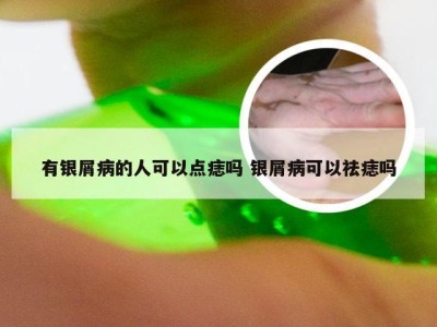 有银屑病的人可以点痣吗 银屑病可以祛痣吗