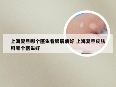 上海复旦哪个医生看银屑病好 上海复旦皮肤科哪个医生好