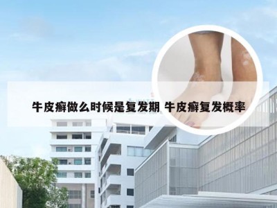 牛皮癣做么时候是复发期 牛皮癣复发概率