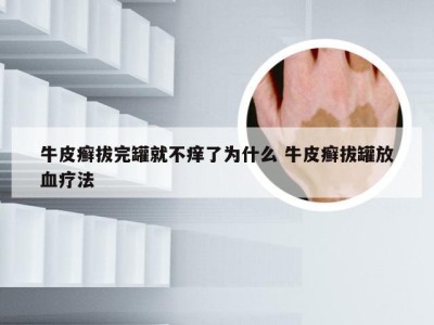 牛皮癣拔完罐就不痒了为什么 牛皮癣拔罐放血疗法