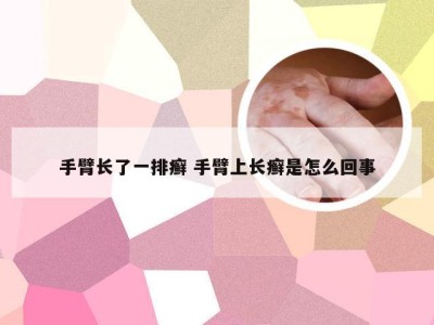 手臂长了一排癣 手臂上长癣是怎么回事