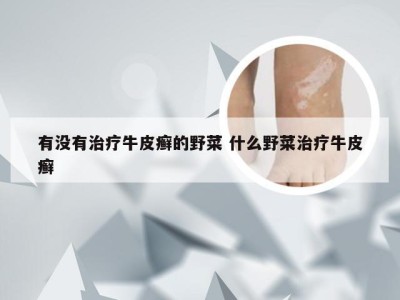 有没有治疗牛皮癣的野菜 什么野菜治疗牛皮癣