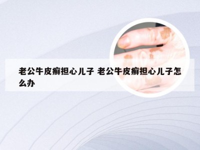 老公牛皮癣担心儿子 老公牛皮癣担心儿子怎么办