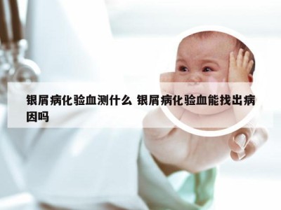 银屑病化验血测什么 银屑病化验血能找出病因吗
