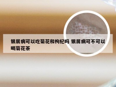 银屑病可以吃菊花和枸杞吗 银屑病可不可以喝菊花茶