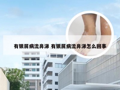 有银屑病流鼻涕 有银屑病流鼻涕怎么回事