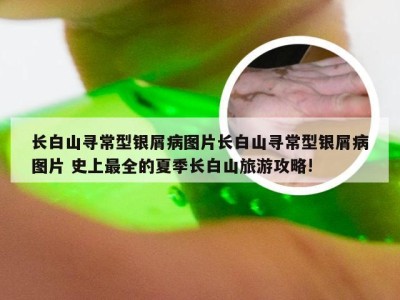 长白山寻常型银屑病图片长白山寻常型银屑病图片 史上最全的夏季长白山旅游攻略!