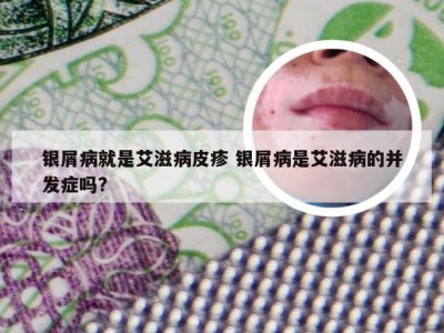 银屑病就是艾滋病皮疹 银屑病是艾滋病的并发症吗?