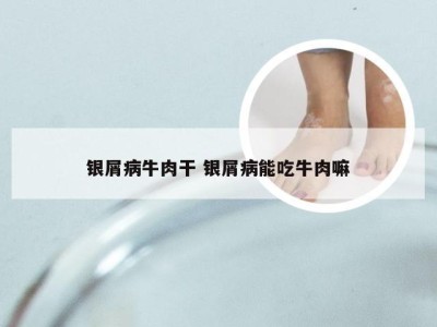 银屑病牛肉干 银屑病能吃牛肉嘛