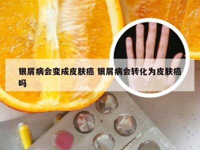 银屑病会变成皮肤癌 银屑病会转化为皮肤癌吗