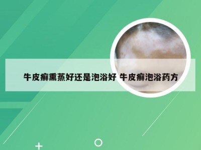 牛皮癣熏蒸好还是泡浴好 牛皮癣泡浴药方