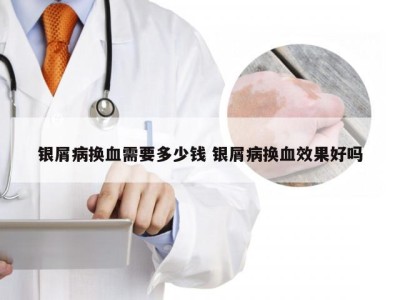 银屑病换血需要多少钱 银屑病换血效果好吗